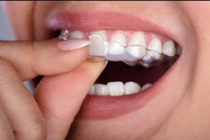 The Guide to Alignment or Straightening of the Teeth with Aligners